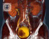 cancer-de-vejiga-sintomas