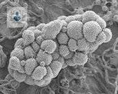 sintomas-de-cancer-de-ovario