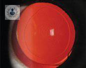 lente-intraocular