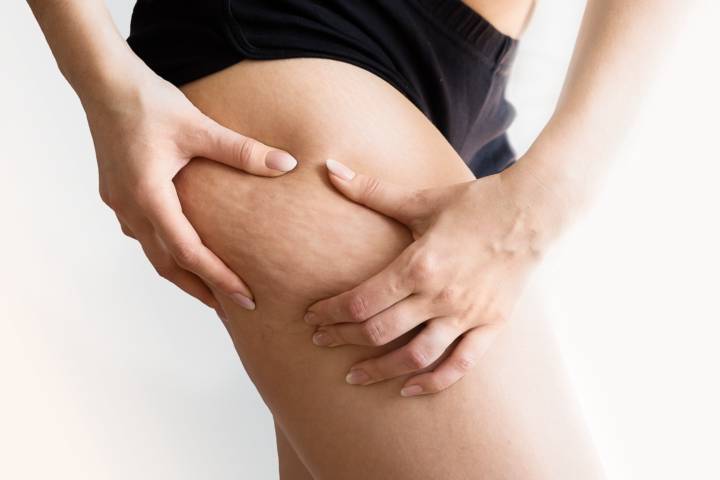 lipedema-enfermedad-tejido-adiposo imagen de artículo