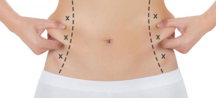 liposuccion-una-tecnica-para-modelar-el-cuerpo imagen de artículo