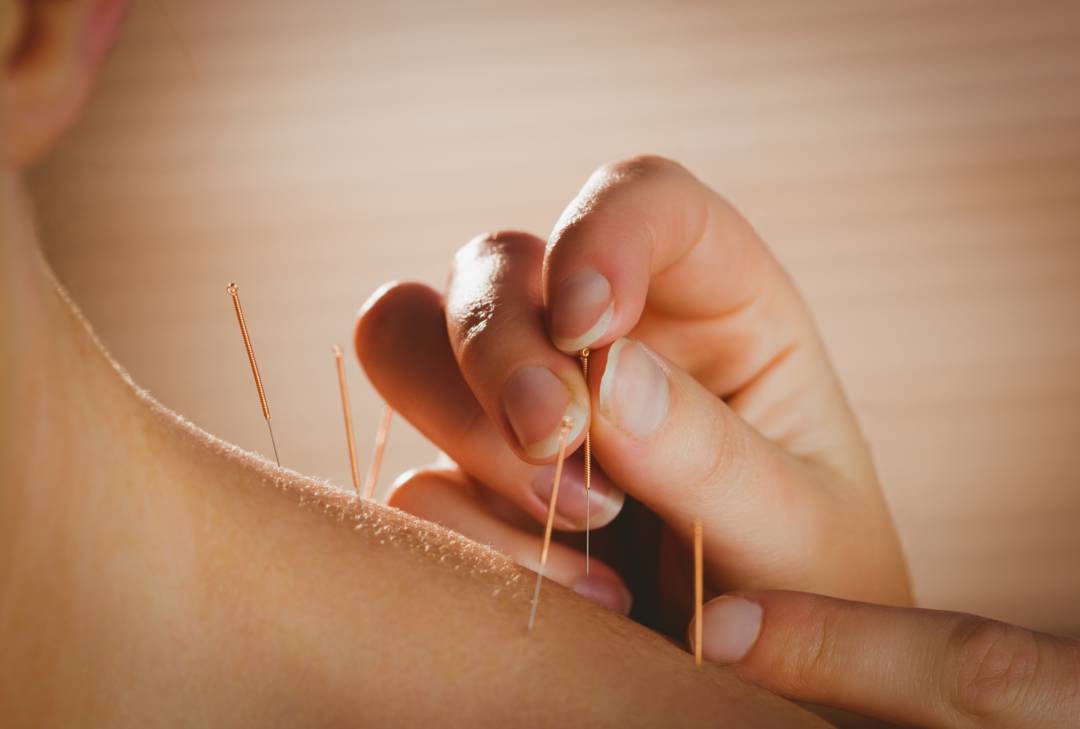 acupuntura-remedio-natural-mejorar-salud imagen de artículo