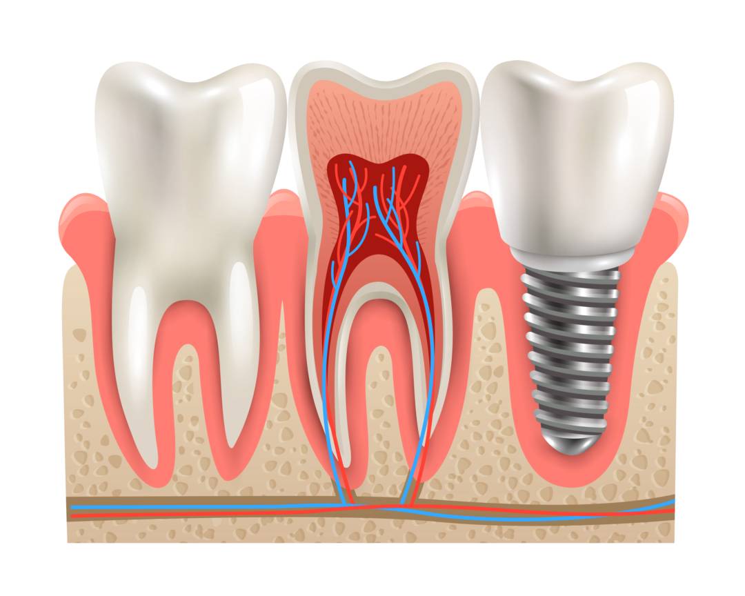 Minitornillos Dentales: anclaje en Ortodoncia para un tratamiento preciso