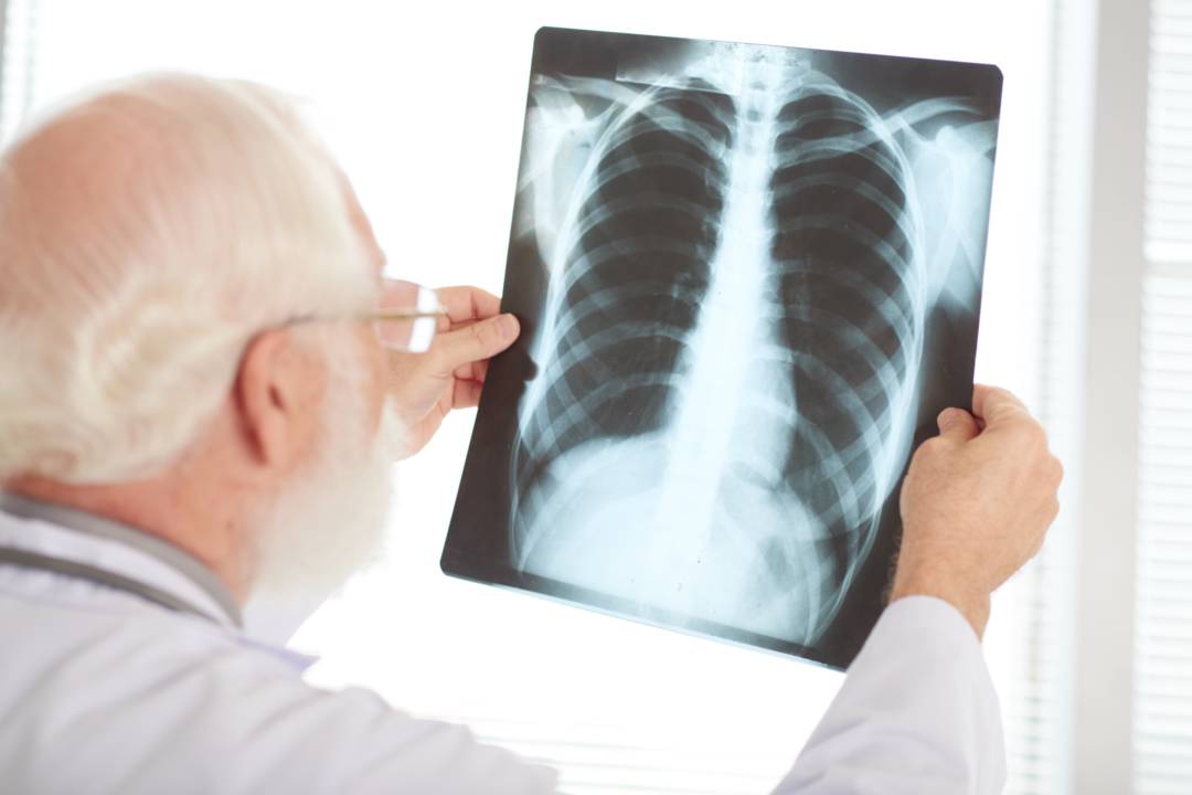 ¿Cómo identifica el paciente que padece un Nódulo Pulmonar? 