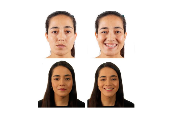 cirugia-ortognatica-que-cambios-esteticos-conlleva imagen de artículo