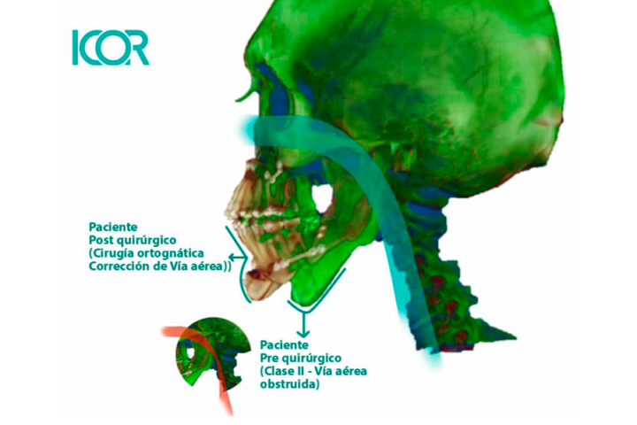 beneficios-cirugia-ortognatica imagen de artículo