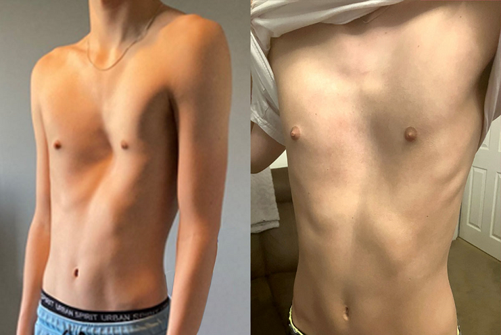pectus-excavatum-un-trastorno-de-la-pared-toracica imagen de artículo