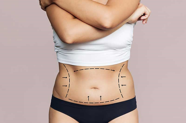 logratus-objetivos-la-abdominoplastia-es-el-procedimiento-ideal-para-ti imagen de artículo