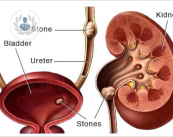 Cálculos renales o vesicales, enfermedad común del riñón o de vías urinarias