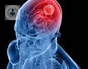 que-es-un-infarto-cerebral