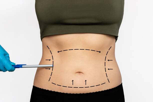 liposuccion-abdominal