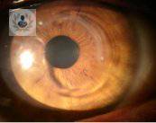 Queratocono, deformación de la córnea y pérdida de la visión