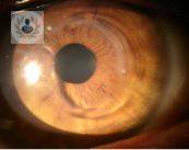 cornea