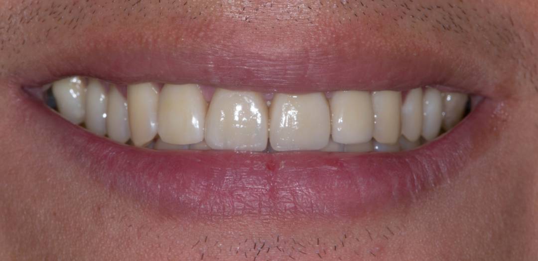 Carillas Dentales: ¿Las necesito o con un Blanqueamiento se resuelve mi problema?