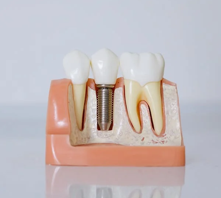 Rehabilitación sobre Implantes Dentales: evaluando sus ventajas