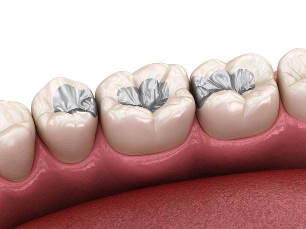 protege-tu-salud-dental-protocolo-para-un-retiro-seguro-de-amalgamas imagen de artículo