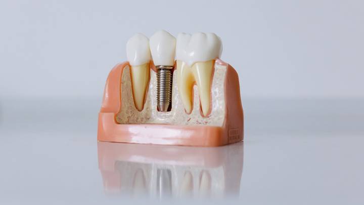 implantologia-bucomaxilofacial-tecnologia-para-una-mejor-calidad-de-vida imagen de artículo