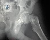 Osteoporosis, disminución de los huesos