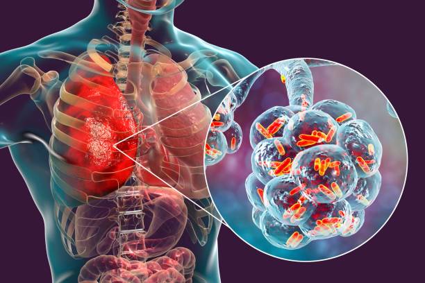 klebsiella-pneumoniae-un-patogeno-de-suma-importancia imagen de artículo