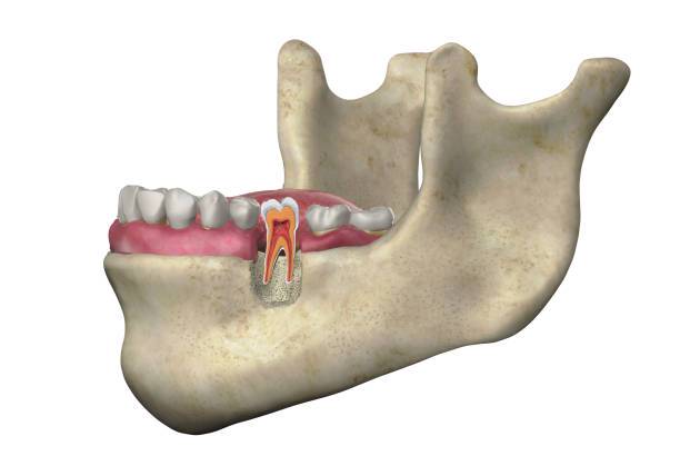 Tratamiento de la Atrofia Maxilar: Comprendiendo los Injertos Óseos y la Implantación Dental