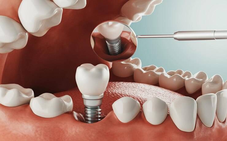 implantes-carga-inmediata-que-son-que-beneficios-ofrecen imagen de artículo