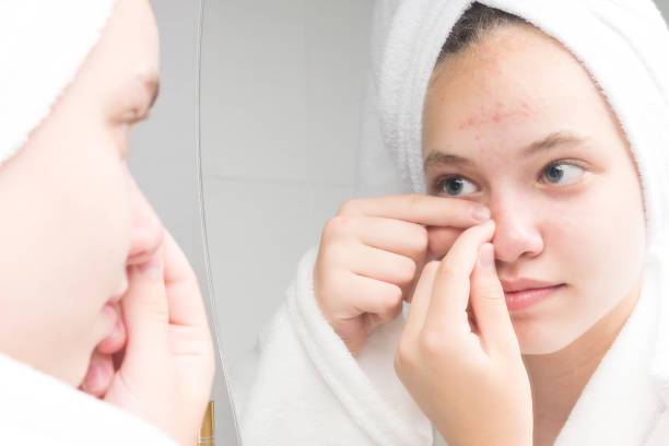 acne-en-la-adolescencia-rompiendo-mitos-y-encontrando-soluciones imagen de artículo