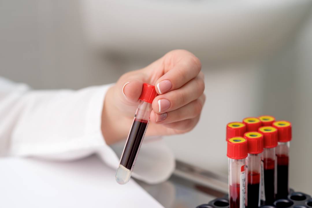 alzheimer-nuevo-test-sangre-detecta-mide-avance-92-por-ciento-precision imagen de artículo