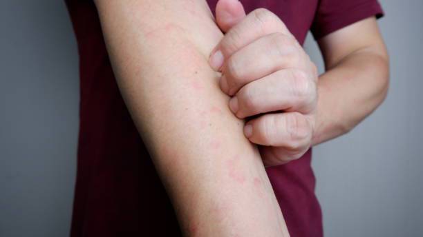 cuando-la-piel-duele-una-mirada-profunda-a-la-dermatitis-atopica imagen de artículo