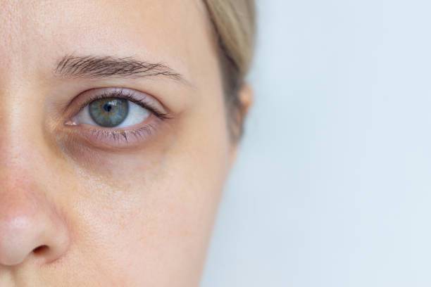 Tratamientos efectivos para Ojeras y Bolsas en Párpados