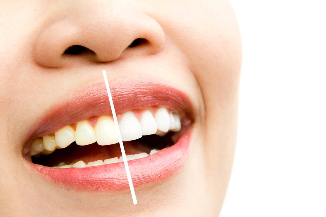 blanqueamiento-dental-como-lograr-mantener-sonrisa-mas-blanca imagen de artículo