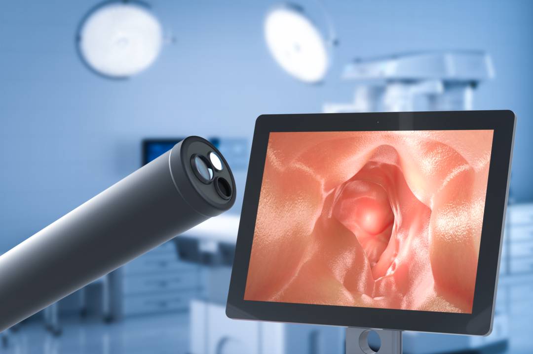 enucleacion-prostatica-laser-holmio-opcion-avanzada-segura-tratar-hiperplasia-prostatica-benigna imagen de artículo