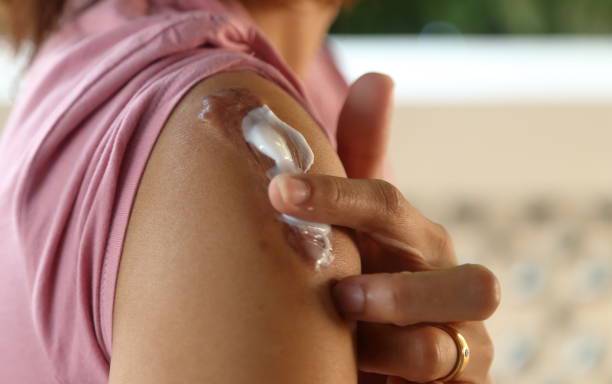 Comprendiendo la Cicatriz Queloide: de la biología a las estrategias terapéuticas