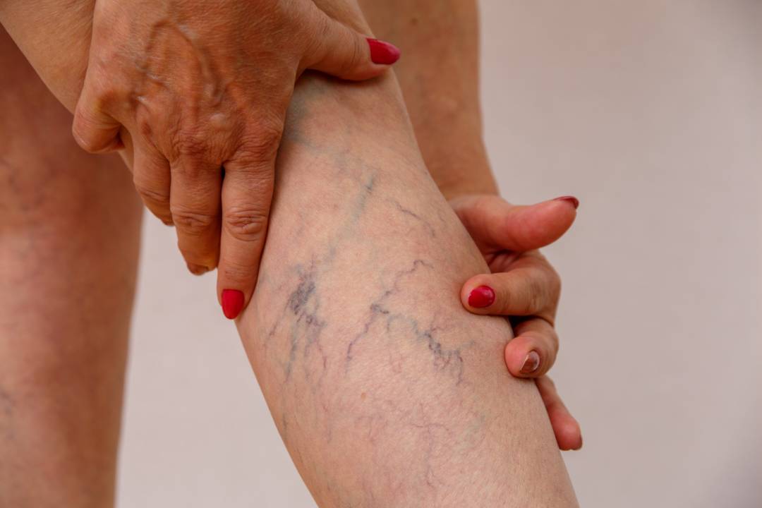 que-hacer-si-tienes-varices-causas-sintomas-tratamientos-mas-seguros imagen de artículo