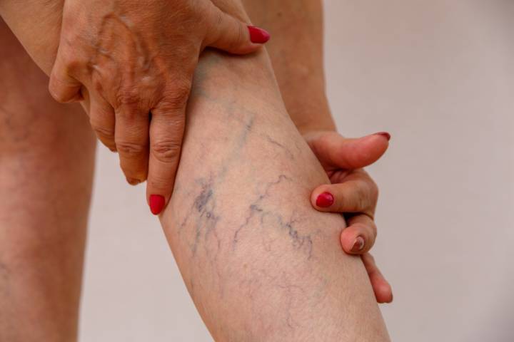 que-hacer-si-tienes-varices-causas-sintomas-tratamientos-mas-seguros imagen de artículo