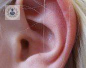 Otoplastia, cirugía para orejas prominentes