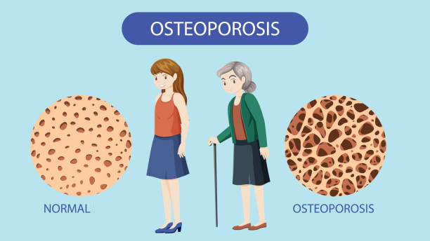 que-es-osteoporosis