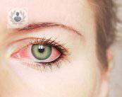 glaucoma-congenito