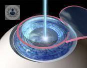 cirugia-lasik