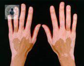 Vitiligo: qué es y cómo atenderlo (P2)