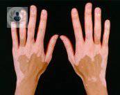 vitiligo