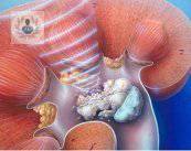 litotricia-extracorporea