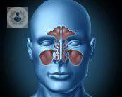 sinusitis-sintomas