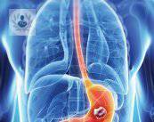 cancer-gastrico