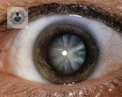 Cataratas: una cura muy sencilla que evita la ceguera (P1)