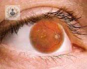 retinopatia-diabetica