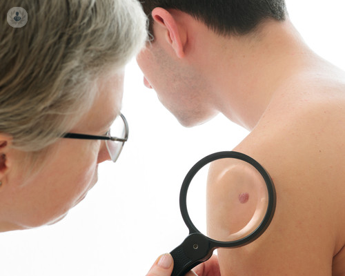 melanoma