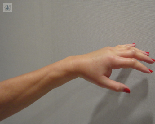 glomerulonefritis-membranosa