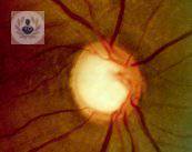 Glaucoma, una enfermedad silenciosa