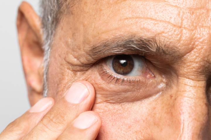 glaucoma-sintomas