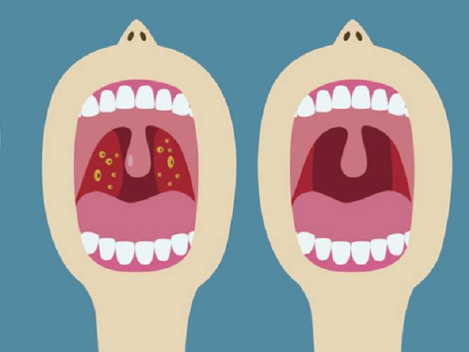 patologia-de-amigdalas-y-adenoides-en-ninos imagen de artículo